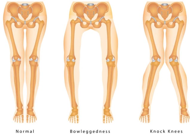 Bowleggedness-knock-knees
