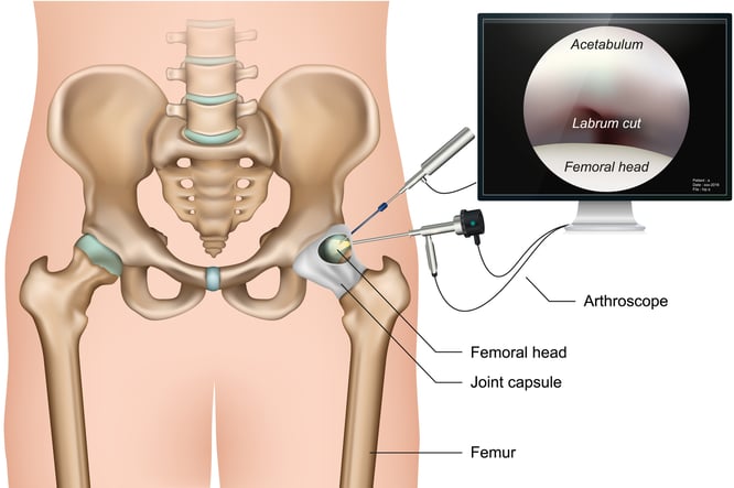 hip_preservation_surgery