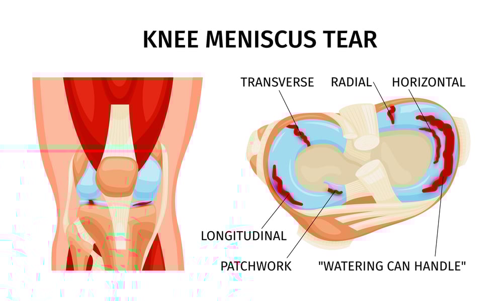 meniscus_tear