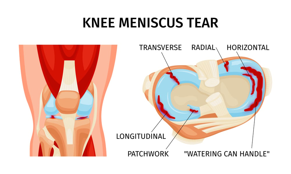 meniscus_tear