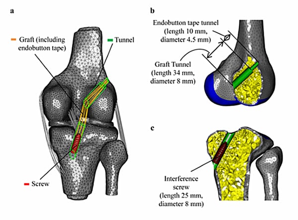 ACL reconstruction_2