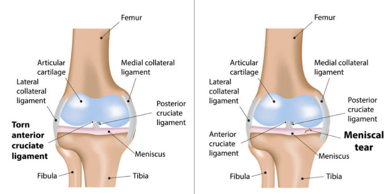 ACL tear meniscus injury tear