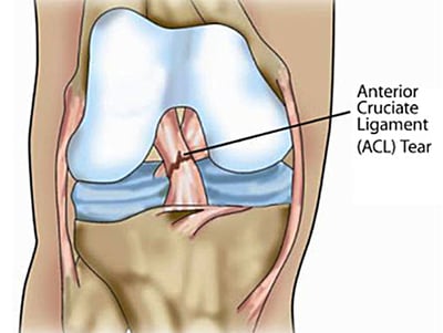 Anterior-cruciate-ligament (ACL) tear