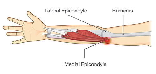 Epicondyle