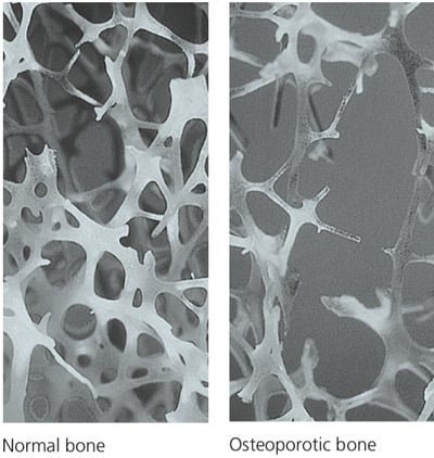 Osteoporosis-2