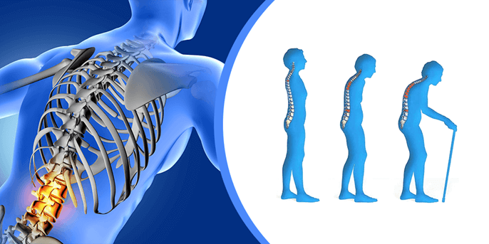 Osteoporosis-4