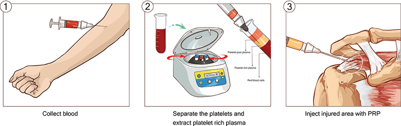 PRP-process-1