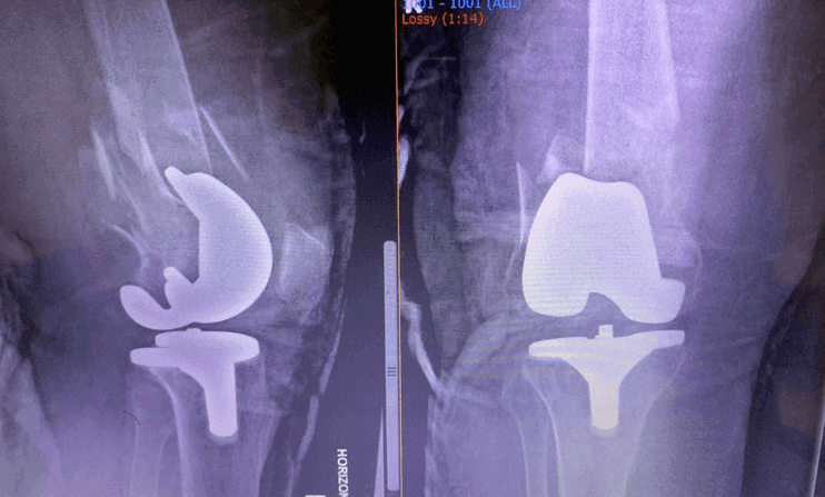 Picture1-megaprosthesis