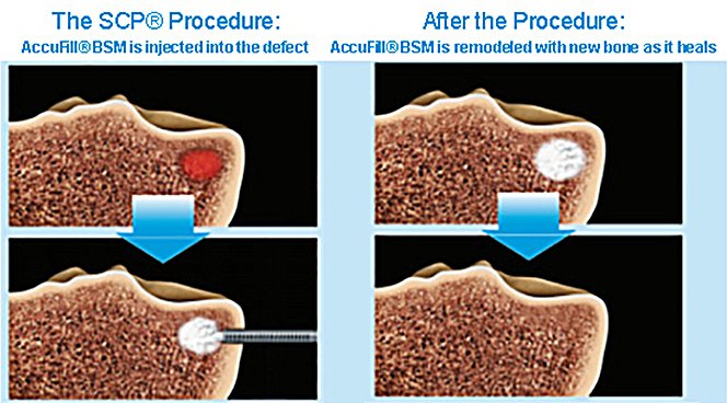 Subchondroplasty-procedure.jpg