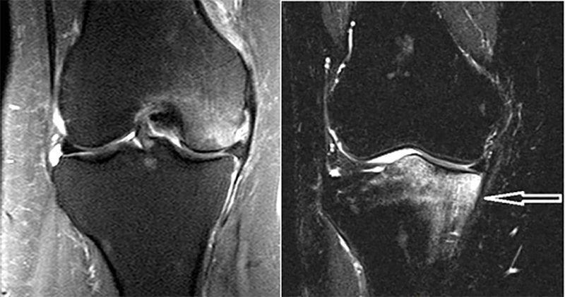 Subchondroplasty-x-ray