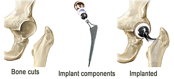Total Hip Replacements-4