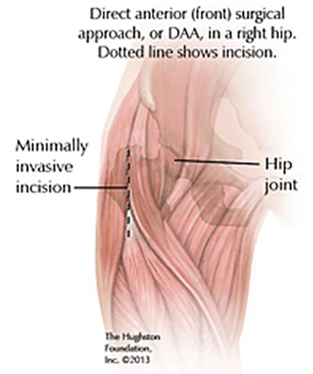 Total Hip Replacements-6