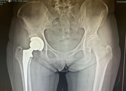 Total Hip Replacements-x-ray-1-after