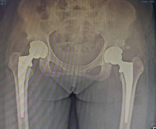 Total-Hip-Replacements-x-ray-3
