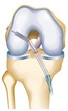 acl reconstruction surgery