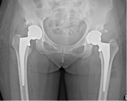 after hip replacement surgery