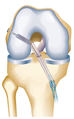 an arthroscopic (keyhole) assessment