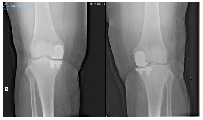 bilateral uka implants knee