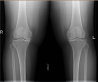 both knees arthritis xray