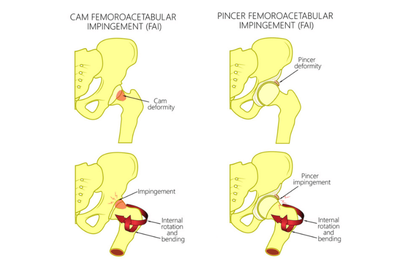 cam pincer fai hip pain