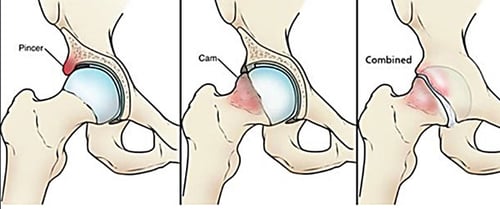 femoral-acetabular-impingement