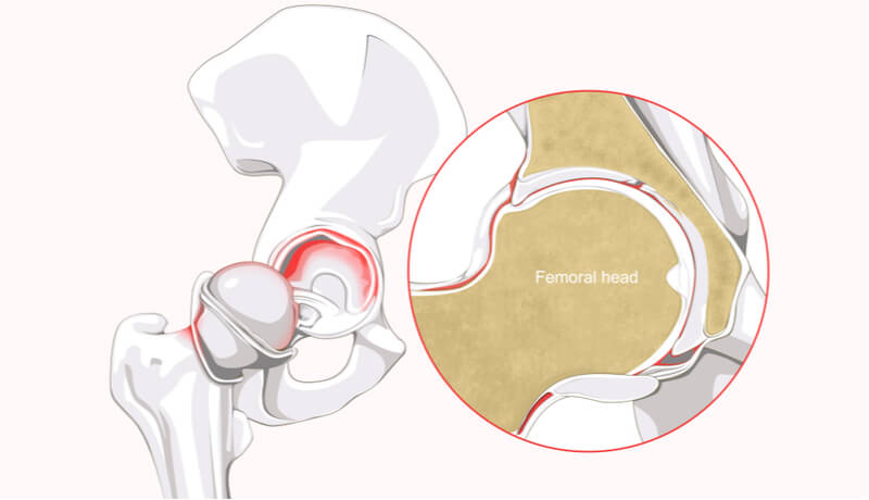 hip labrum tear