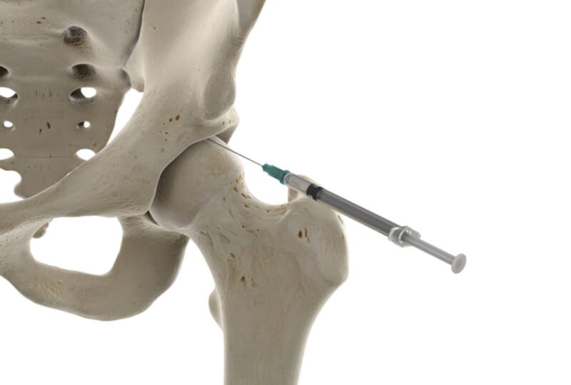 hip preservation technique intra articular injection