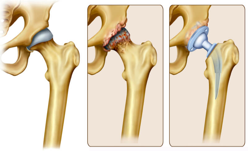 how is hip replacement performed