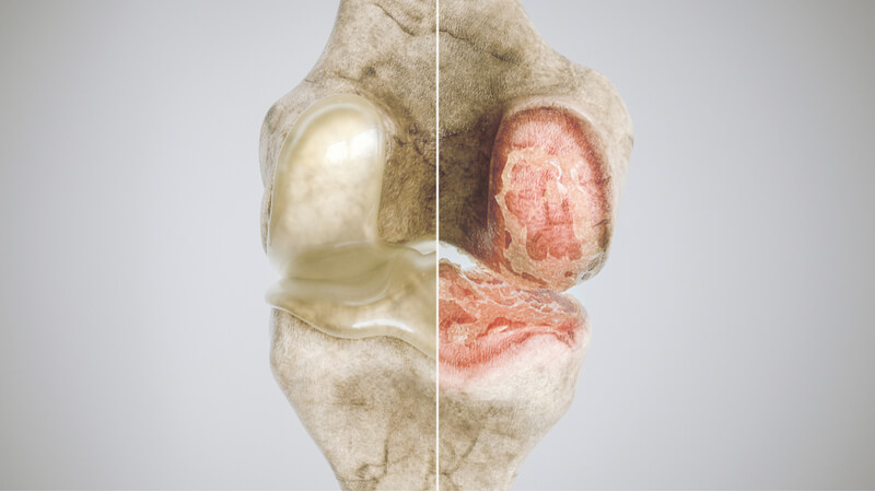 knee arthritis pain