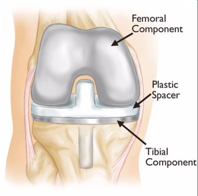 knee replacement-1