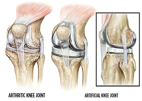 knee replacement-2