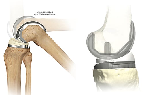 knee replacement-3