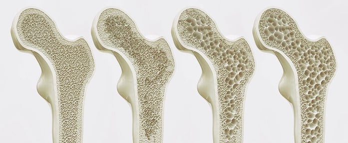 osteoporosis bone cross section diagram
