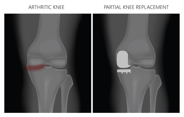 partial knee replacement