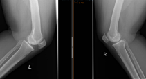 patellofemoral joints preservation-1