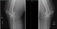 patellofemoral joints preservation-2