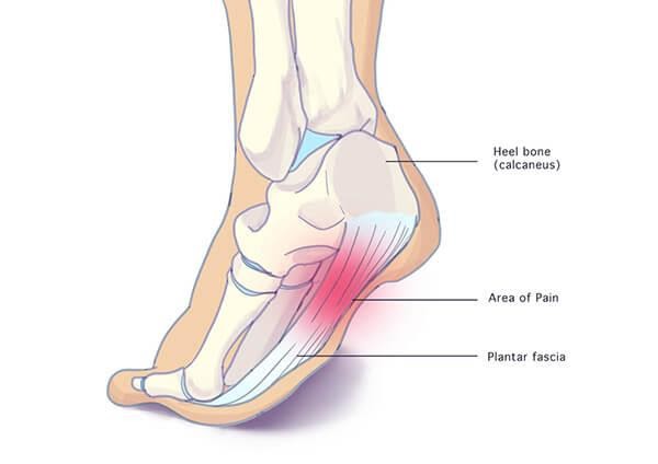 plantar fasciitis diagram2