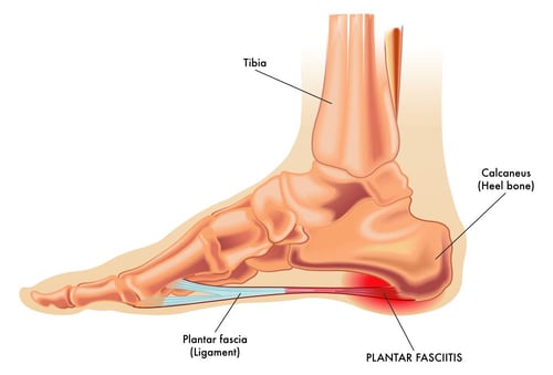 plantar fasciitis foot anatomy