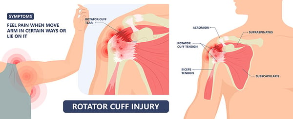 rotator-cuff-tendinitis