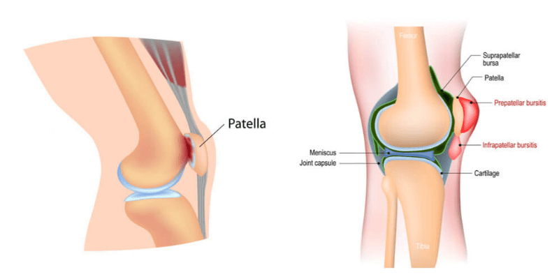 runners knee comparison