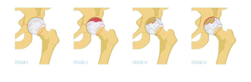 stages of avascular necrosis avn