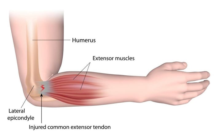 tennis elbow diagram