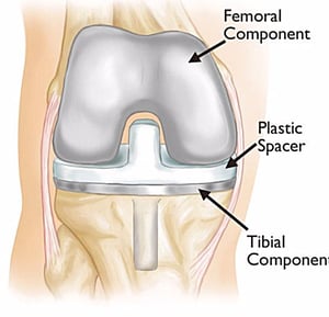 total knee replacement