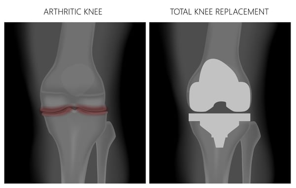 total-knee-replacement-2