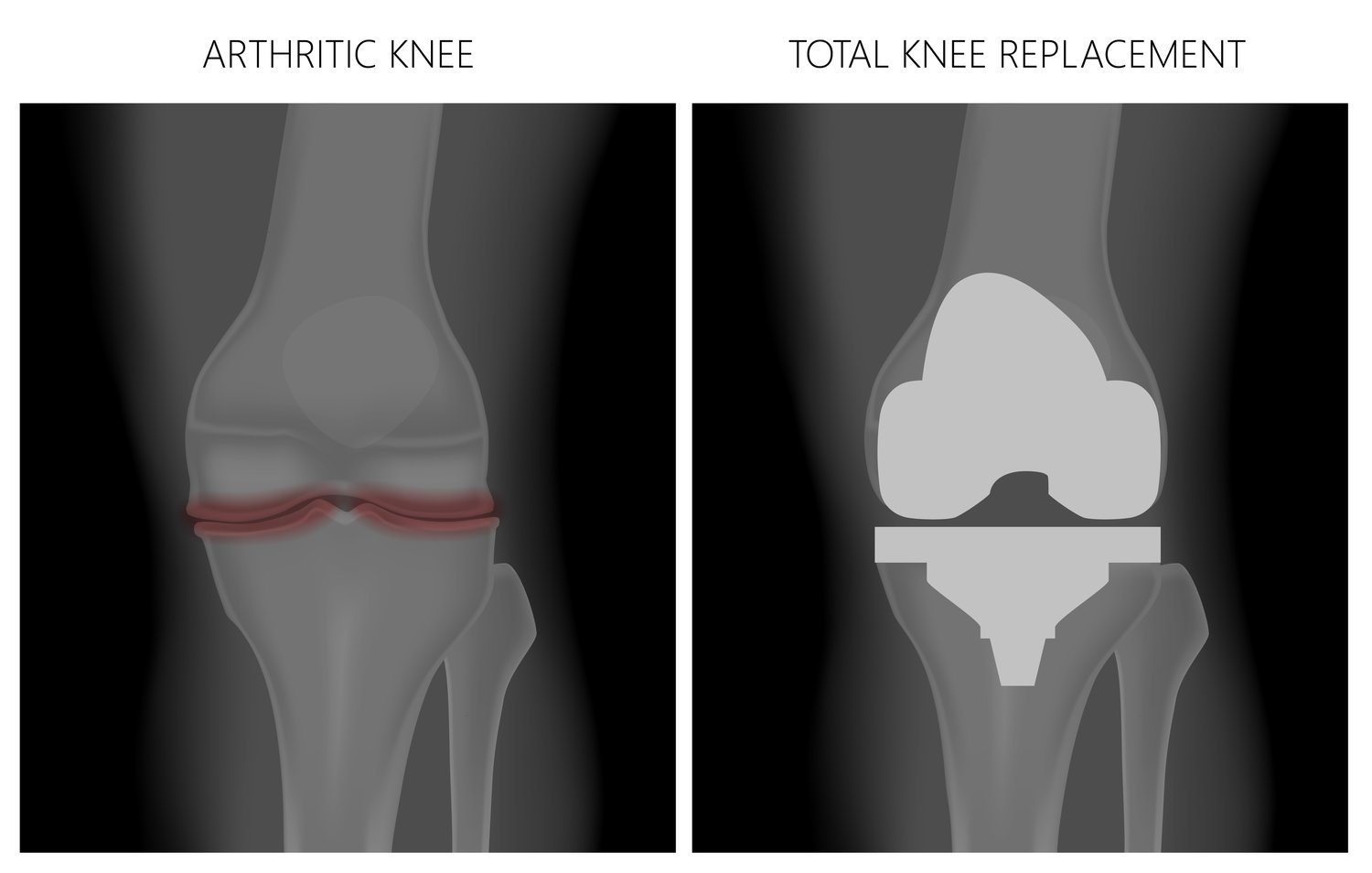 Partial VS Full Knee Replacement Surgery: Which is right for me?