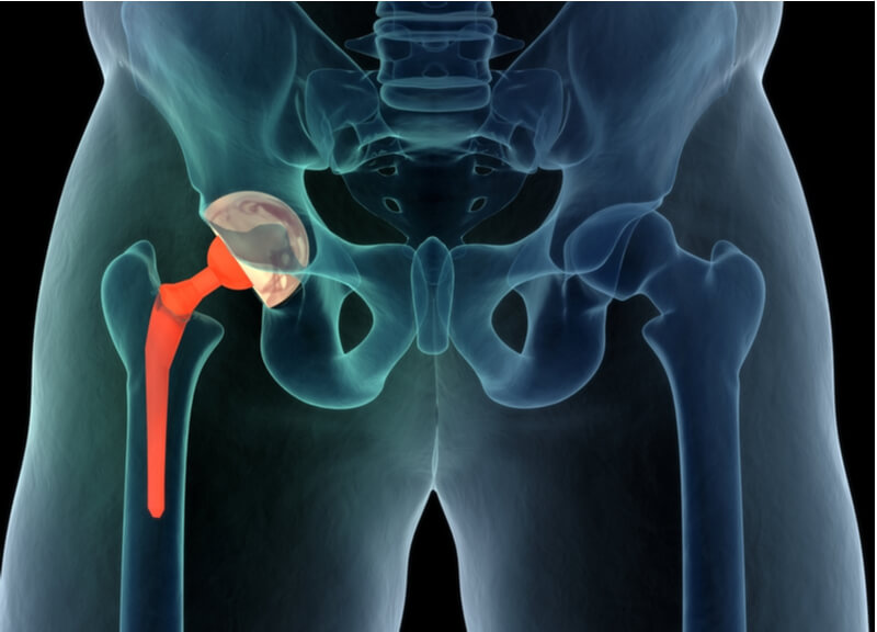 what is a hip replacement