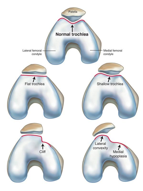 Patella 2