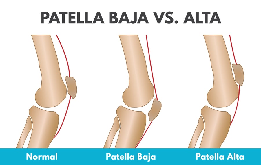 Patella 3
