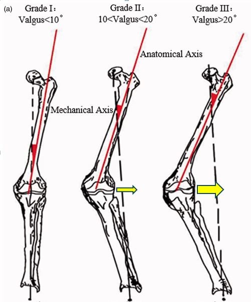 Patella 5