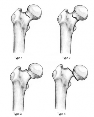 neck-of-femur-fractures